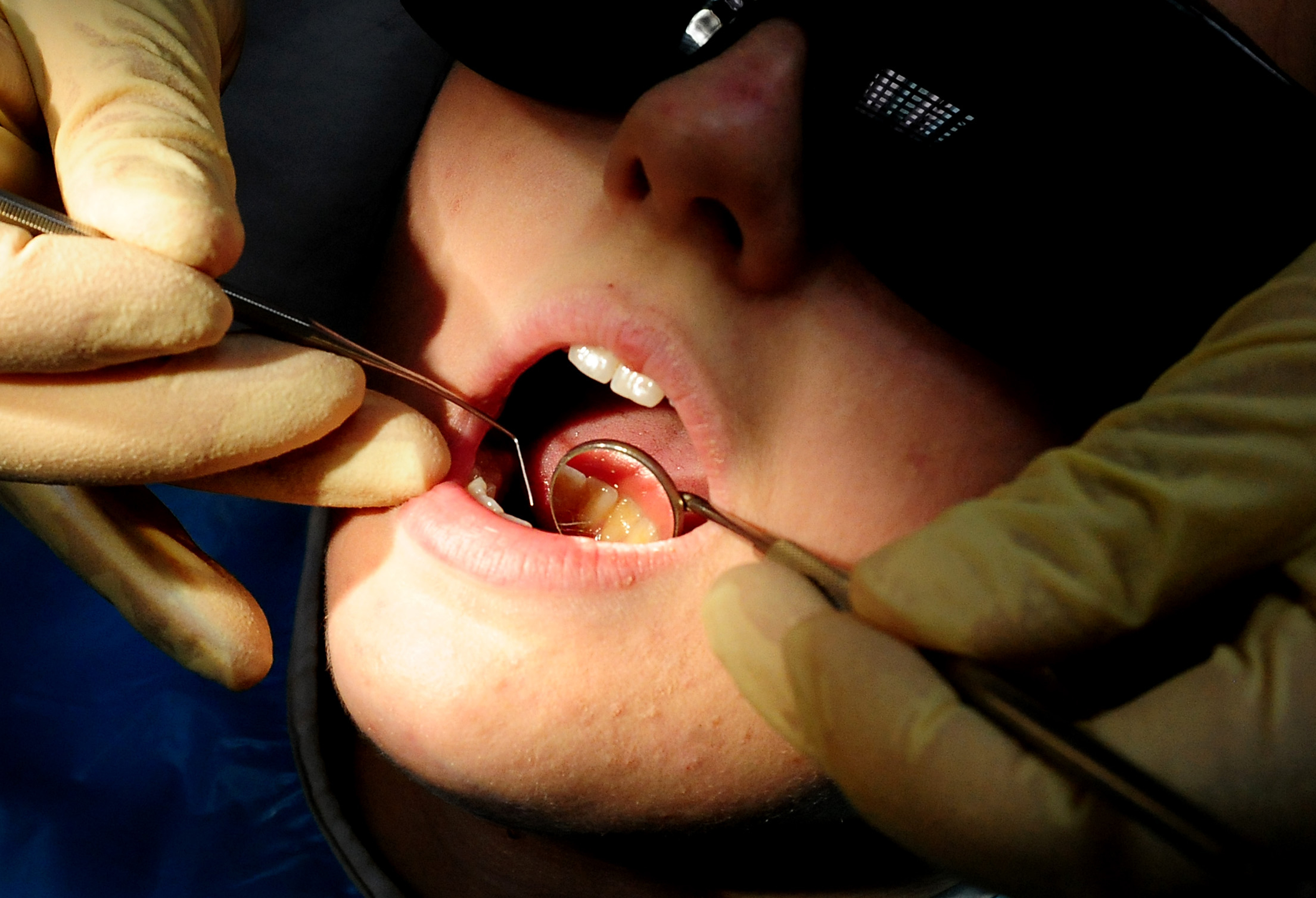 Almost a dozen hospital admissions in East Hampshire to remove children's rotten teeth