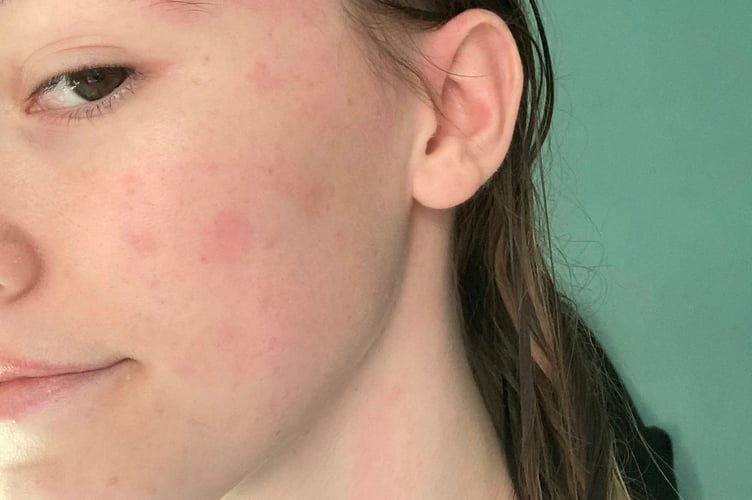 Chloe Ramsay - reaction to water after a shower.  A woman with over 40 allergies - including WATER - has to use a colour-coded spread sheet to keep track of them all.  Chloe Ramsay, 19, was born with lots of food allergies and would even go into anaphylactic shock after eating certain foods - such as bananas and potatoes.  While she no longer ends up hospitalised from allergic reactions thanks to treatments in childhood, she currently has a list of 40 things that can cause her mouth and throat to swell up dangerously, or bring her skin up in hives.  They include kiwis, strawberries, raspberries, blueberries and grapes.  Chloe was diagnosed with 'pollen food syndrome' - an allergy to any pollen-derived substances - including sweets, fruits, and even perfumes in June 2023.  This explained most of her allergies - but her most unusual is an allergy to WATER, known as aquagenic urticaria. 